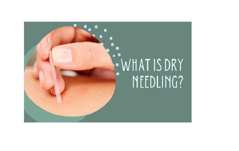 dry needling service