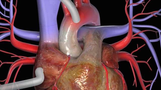 heart bypass surgery in India