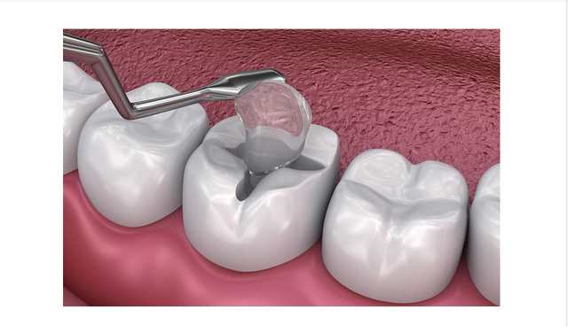 PROTECT YOUR ORAL HYGIENE BY DENTAL FILLINGS SERVICES