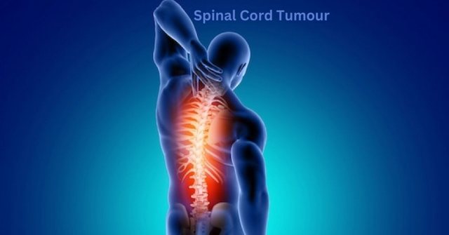 spinal cord tumour surgery